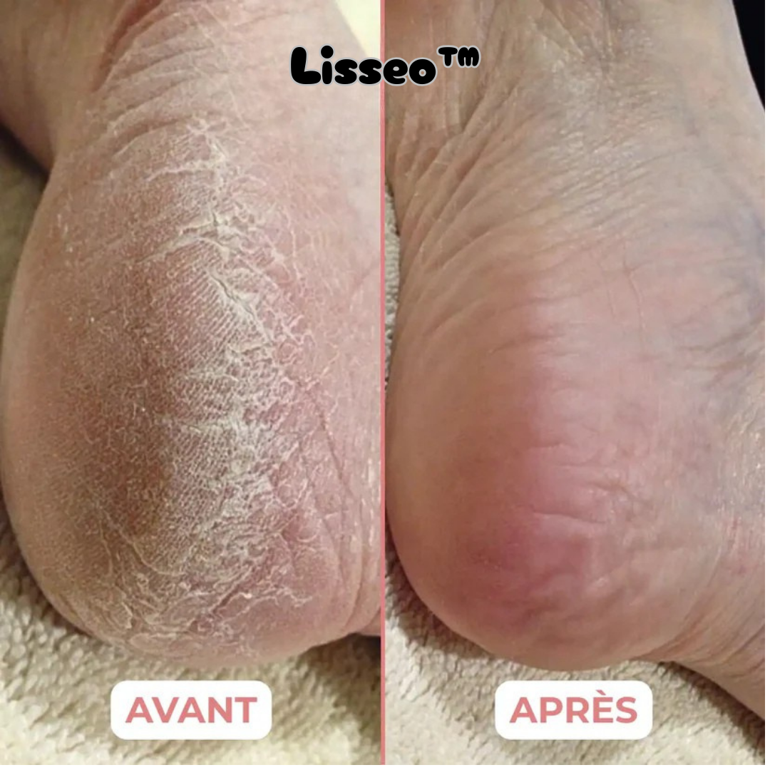 Lisseobalm™ - Baume Hydratant au Miel pour les pieds