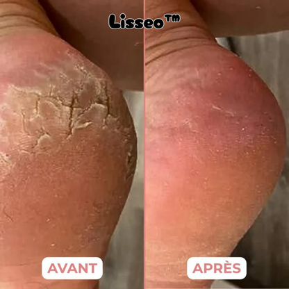 Lisseobalm™ - Baume Hydratant au Miel pour les pieds