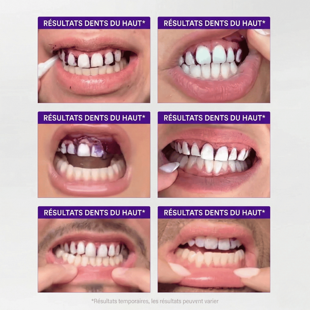 Bandes Blanchissantes  - Smilekit™